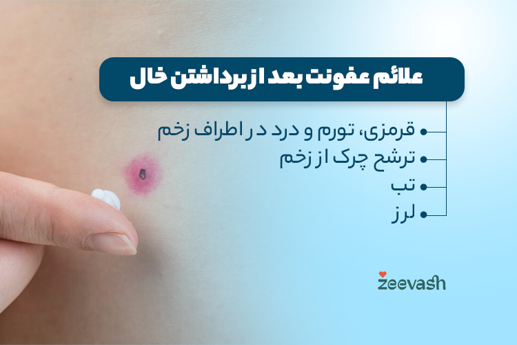 علائم عفونت بعد از برداشتن خال